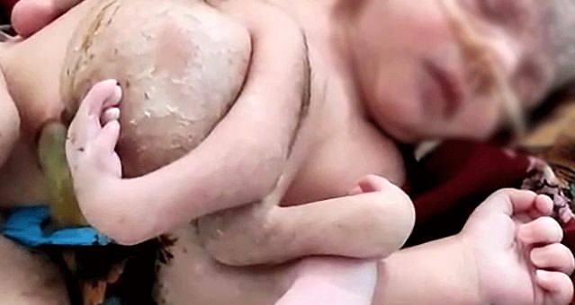 Hindistan'da bir kadın dört bacaklı, üç kollu bir kız çocuğu doğurdu