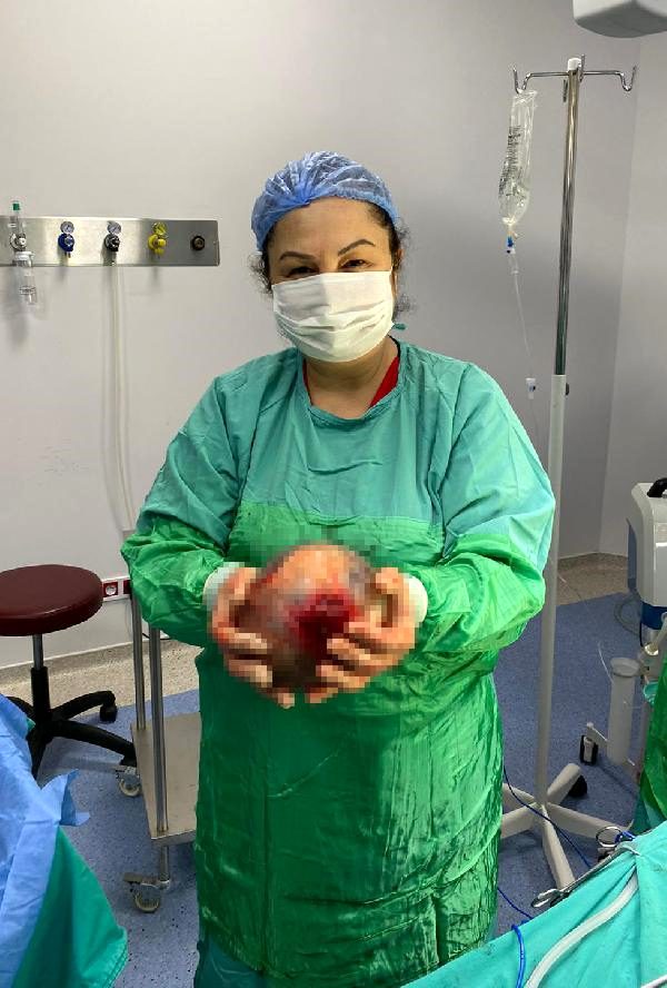 Rahminden 1,5 kiloluk kist çıktı