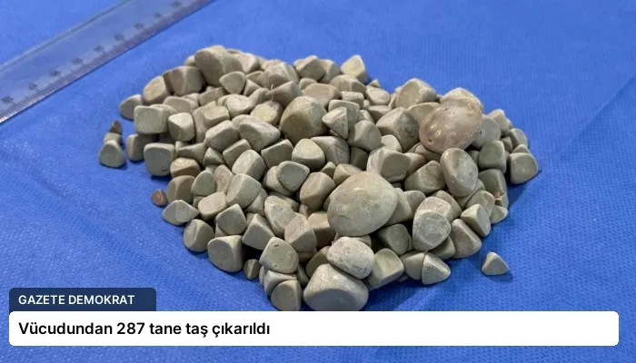 Vücudundan 287 tane taş çıkarıldı