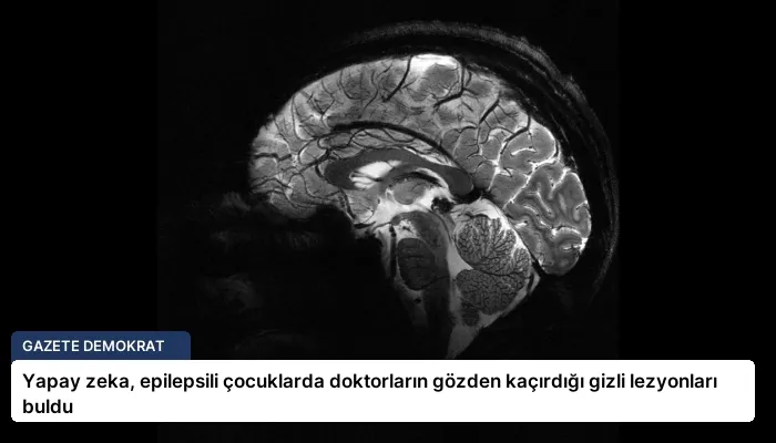 Yapay zeka, epilepsili çocuklarda doktorların gözden kaçırdığı gizli lezyonları buldu