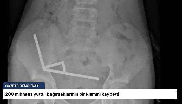 200 mıknatıs yuttu, bağırsaklarının bir kısmını kaybetti