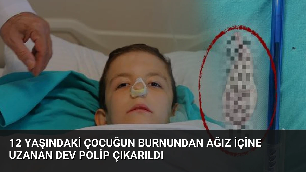 12 Yaşındaki Çocuğun Burnundan Ağız İçine Uzanan Dev Polip Çıkarıldı
