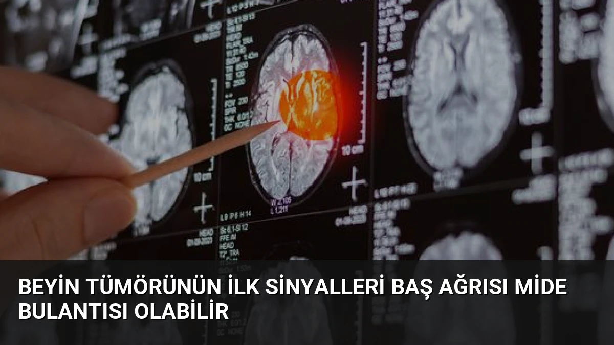 Beyin Tümörünün İlk Sinyalleri Baş Ağrısı Mide Bulantısı Olabilir
