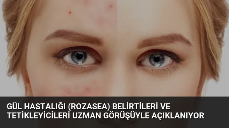 Gül Hastalığı (Rozasea) Belirtileri ve Tetikleyicileri Uzman Görüşüyle Açıklanıyor