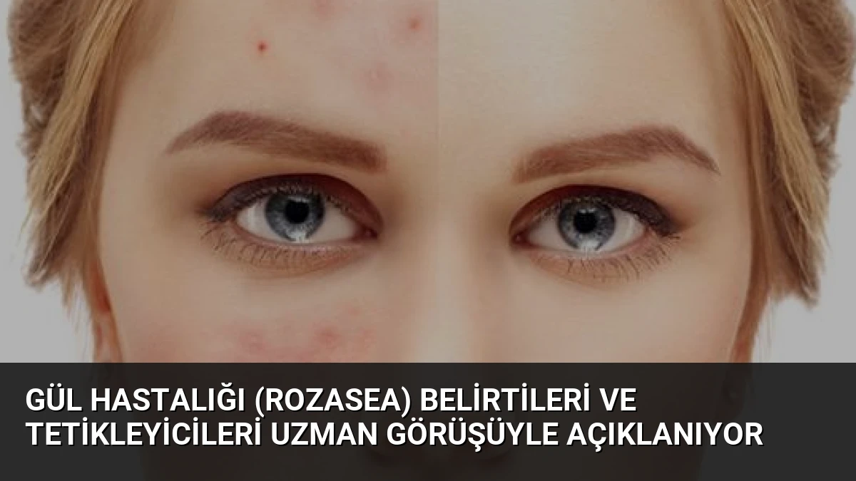 Gül Hastalığı (Rozasea) Belirtileri ve Tetikleyicileri Uzman Görüşüyle Açıklanıyor