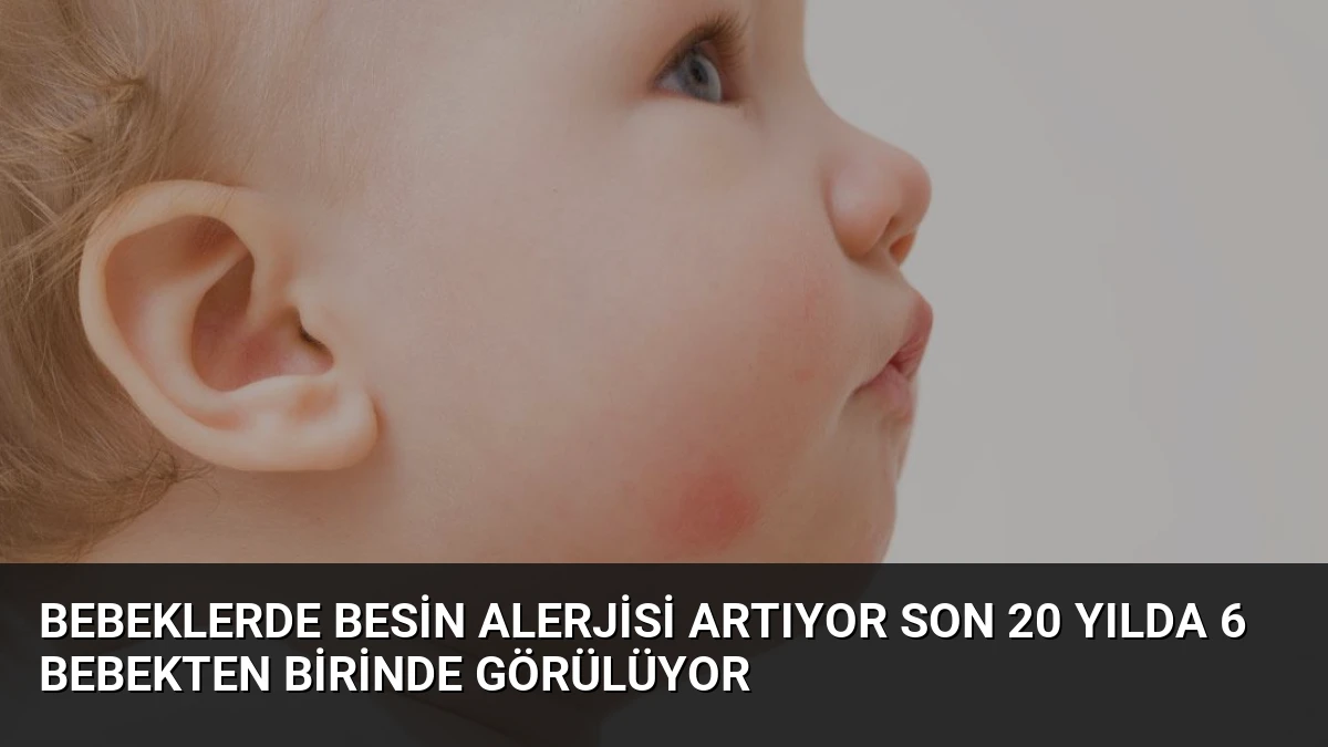 Bebeklerde Besin Alerjisi Artıyor Son 20 Yılda 6 Bebekten Birinde Görülüyor
